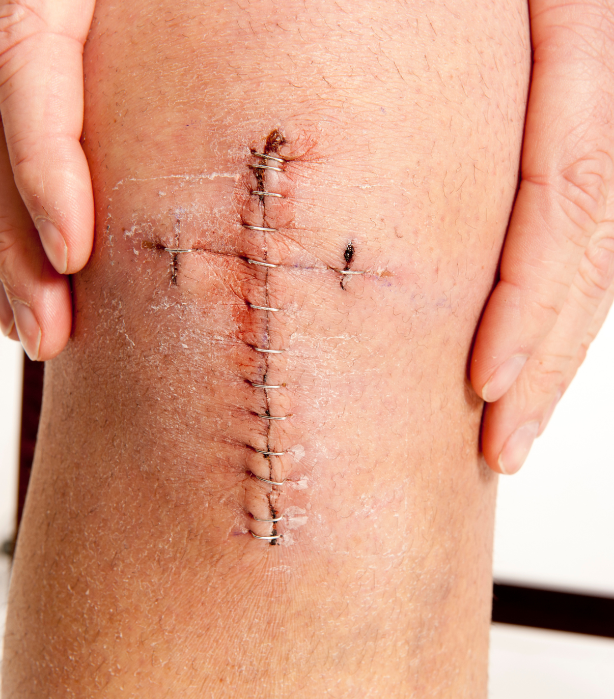 Stitches, Wounds & Sensitive Scars - My Ortho Clinic