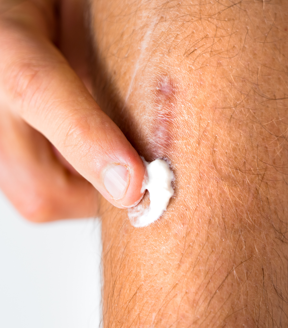 Scar Care After Stitches: Tips for Optimal Healing – Motivo Scar Care