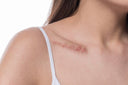 How to Choose the Right Scar Care Product for Your Needs