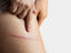 Understanding Scar Formation: How to Prevent and Treat